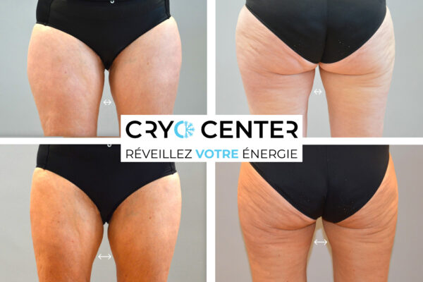 Cryolipolyse des cuisses : Indications, déroulement, prix